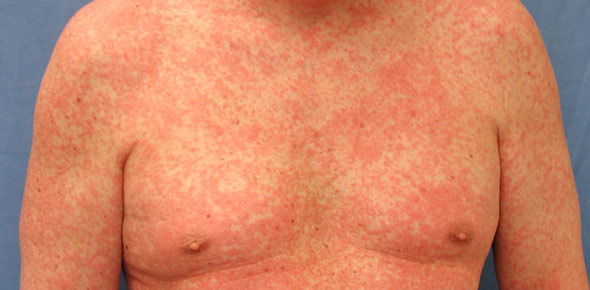 Sepsis Management Quizzes & Trivia