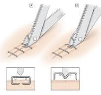 Staple Removal Quiz