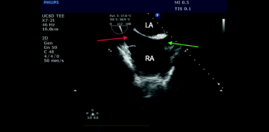 Virtual TEE: Transesophageal Echocardiography Essentials Test! Trivia Quiz