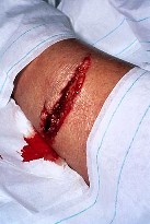 open wound