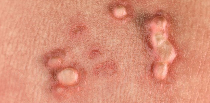 Genital warts and genital herpes are two infections people tend to mistake for themselves. These Genital warts and genital herpes are two infections people tend to mistake for themselves. These